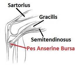 Pes Anserine Bursitis is one of the less common causes of medial knee pain | Rehab & Restoration ...