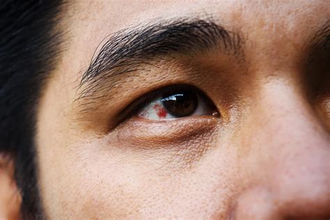 Red Spot on Eye: What It Could Mean | Reader's Digest