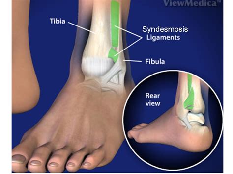 Image Gallery syndesmosis ankle