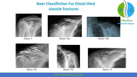 Clavicle Fracture Classification