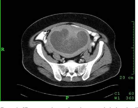 √ Uterus Endometriosis Ct Scan / Tumors Of The Uterine Corpus Clinical Gate : The best way to ...