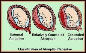 SOLUSIO PLASENTA (PLASENTA LEPAS SEBELUM WAKTUNYA)