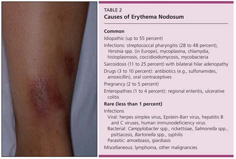 Causes of Erythema Nodosum Common - Idiopathic (up ... | GrepMed