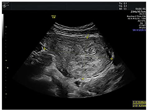 Gray scale ultrasound aspect of the 10 cm fibroid. | Download ...