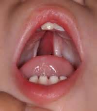 Cleft palate surgery for children - Children's Minnesota