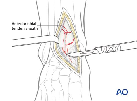 Anteromedial approach to the distal tibia