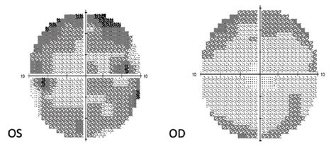 Imaging in Hydroxychloroquine Toxicity - Retina Today