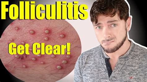 Scalp Folliculitis Natural Treatment