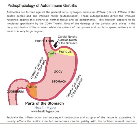 Auto-Immune Atrophic Gastritis: malabsorption - can lead to NET tumours |Atrophic Gastritis ...