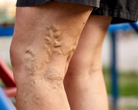 Varicose Veins: 5 Signs You Should See a Doctor | Vein Center in Walnut ...