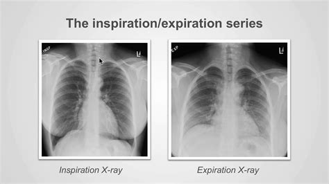 Types Of Chest X Ray