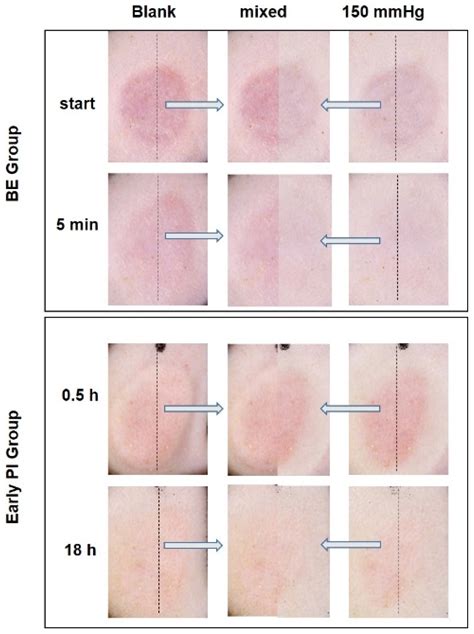 Diagnostics | Free Full-Text | Establishing an Appropriate Pressure for the Transparent Disc ...