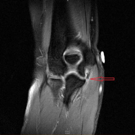 right elbow Mri with contrast showing complete tear of the UCL... | Download Scientific Diagram