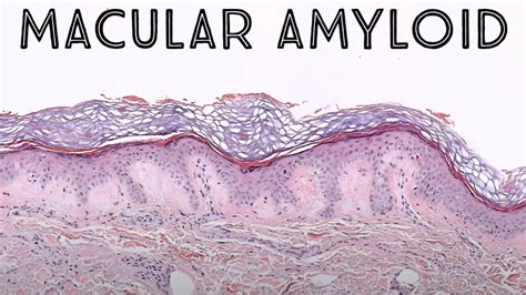 Macular amyloid (keratin derived amyloid - NOT systemic amyloidosis ...