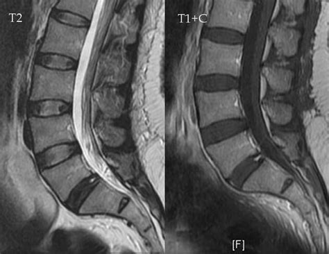 Annular tear L5/S1 | Radiology Case | Radiopaedia.org | Annular, Radiology, Degenerative disc