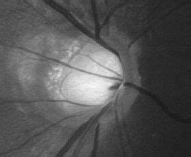 Optic Nerve imaging modalities