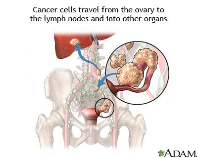 Ovarian cancer metastasis: MedlinePlus Medical Encyclopedia Image