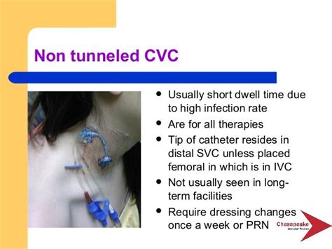 Superb Tricks For Cpt Code For Tunneled Central Venous