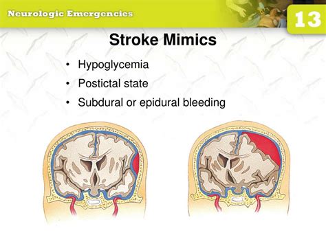 PPT - 13: Neurologic Emergencies PowerPoint Presentation, free download - ID:1267278