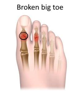 Broken Big Toe: Causes Symptoms Diagnosis and Treatments - The Health Experts