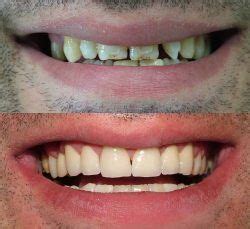 Before and After Zirconium Crowns - Maltepe Dental Clinic