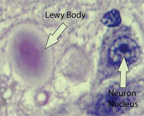 What is Lewy Body Dementia - Causes, Symptoms, Diagnosis, Treatments