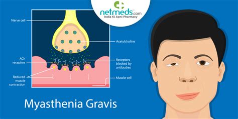 Myasthenia Gravis: Causes, Symptoms And Treatment Of This Autoimmune Disorder