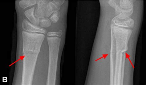 Greenstick fracture distal radius - Lasidouble