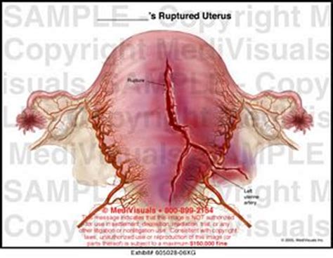 MediVisuals Ruptured Uterus Medical Illustration