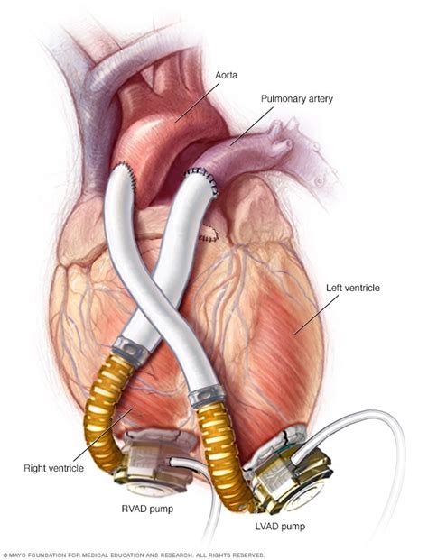 Ventricular assist device (VAD) - Mayo Clinic