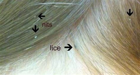 Quick Way To Get Rid Of Nits - Just For Guide