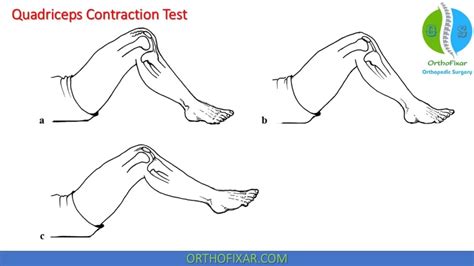 Posterior Sag Sign | OrthoFixar 2025