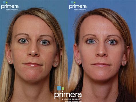 Dermabrasion Before and After Photo Gallery | Orlando, Florida | Primera Plastic Surgery