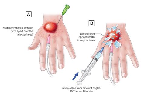 The Dangers of Cannulation & Extravasation Injuries