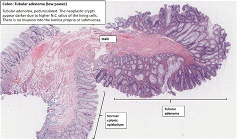 Colon – Polyposis Coli – NUS Pathweb :: NUS Pathweb