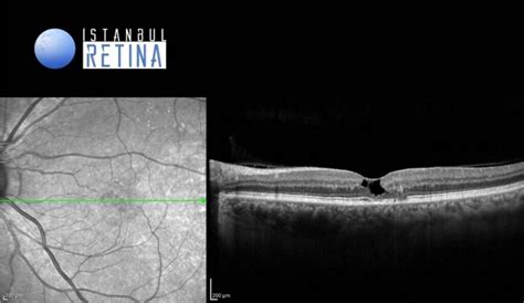 43. Macular Telangiectasia Type 2 | OCT Club