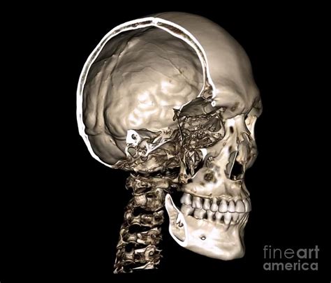 Normal Skull, 3d Ct Scan Photograph by Zephyr | Fine Art America