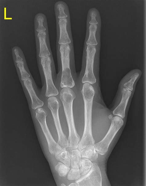 Enchondroma | Radiology Case | Radiopaedia.org | Radiology, Pet ct ...