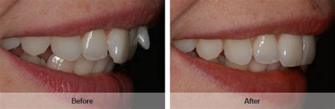 Inman Aligner Braces | mydentist