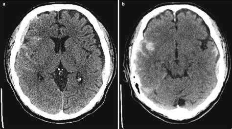 Fig. 7.2, [(a, b) Axial non-contrast CT-scan,...]. - Diseases of the Brain, Head and Neck, Spine ...