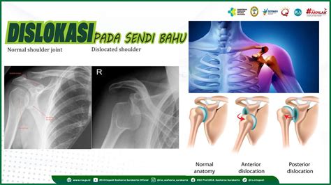 DISLOKASI PADA SENDI BAHU - Rumah Sakit Ortopedi Soeharso Surakarta