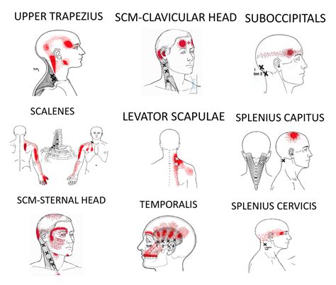 Get Relief From Tension Headaches - The Armoury