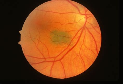 Nevus - Retina Image Bank