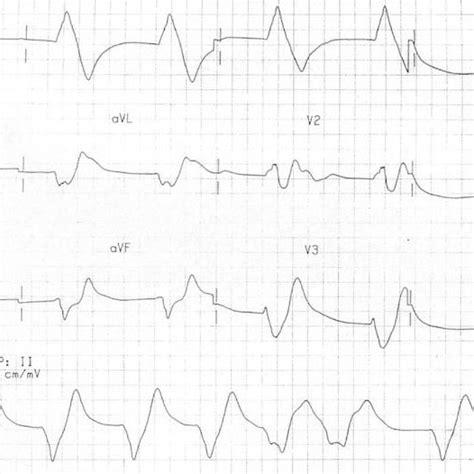 Sine waves in a patient with K + 9.9 mEq/l. ECG is courtesy of #FOAMed ...