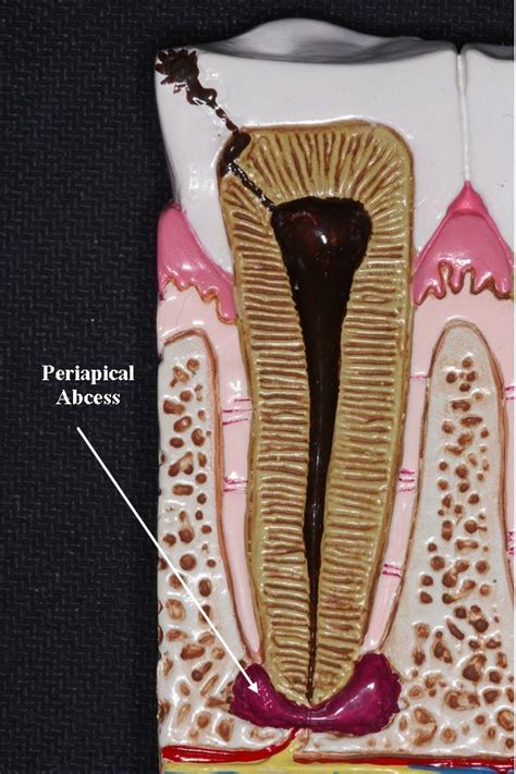 Necrotic pulp/tooth | Ask A Dentist