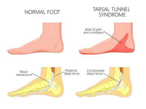 Tarsal Tunnel Syndrome - Symmetry Physical Therapy | Miami