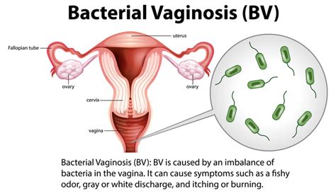 Atopobium vaginae qPCR assay - PCR Assays