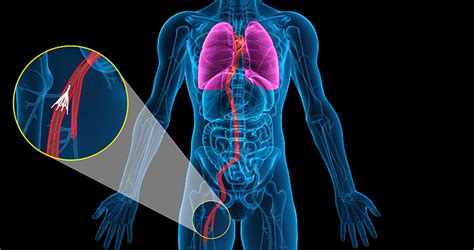 IVC Filter Complications - The Olinde Firm - New Orleans Attorneys