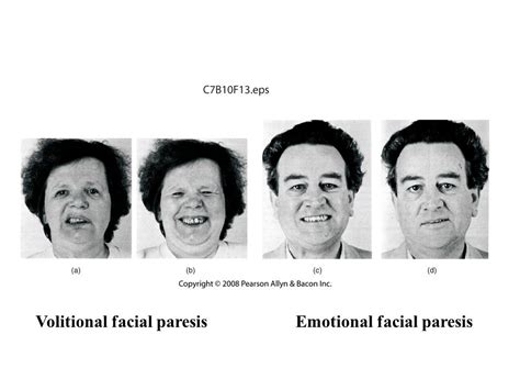 Emotional facial paresis