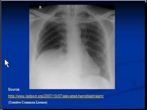 Chest x-ray interpretation --Raised hemidiaphragm - YouTube